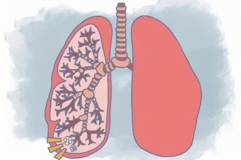 做了肺大泡手术能抽电子烟吗？